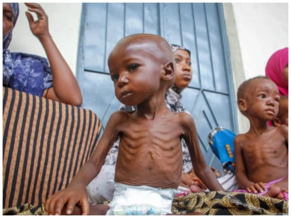 Malnutrition: A national wake-up call