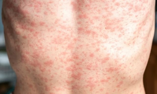 Measles holiday warning as cases rise in Europe