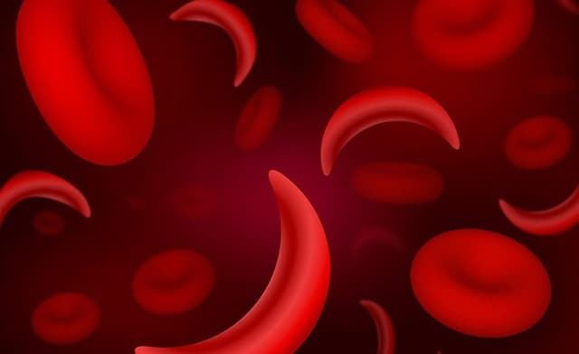 Nigeria records highest cases of sickle cell globally