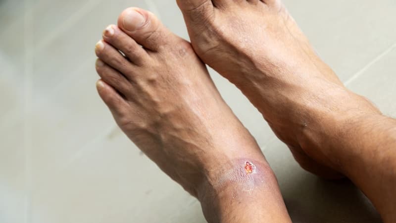 Avoid walking barefoot if you have diabetes — Expert
