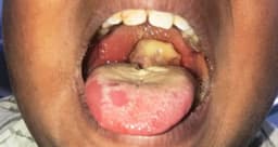 Suspected diphtheria outbreak kills 3 children in Zaria