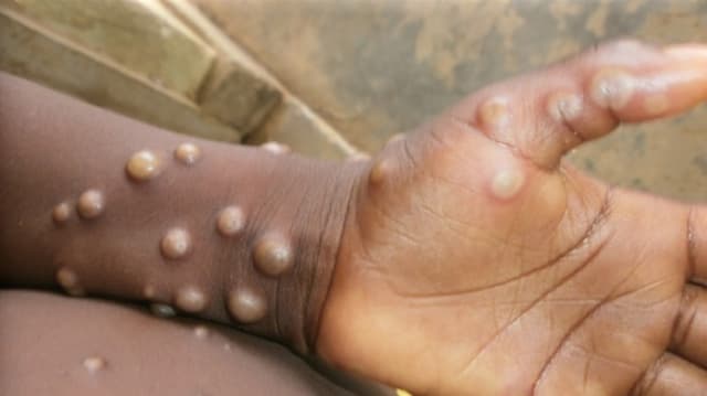 Benue records 31 suspected cases of Mpox in 5 LGAs