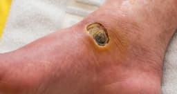 Buruli ulcer outbreak hits Adamawa community