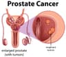 Prostate cancer: 5 early symptoms men shouldn’t ignore