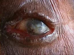 4.24m Nigerians affected by blindness, visual impairment — Sightsavers