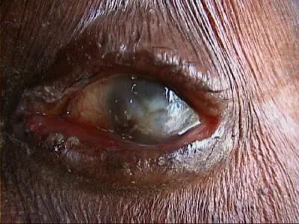4.24m Nigerians affected by blindness, visual impairment — Sightsavers