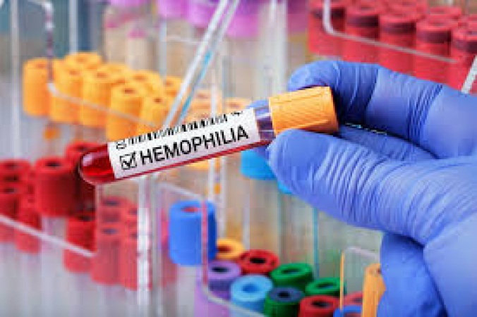 Experts raise alarm over haemophilia under-diagnosis