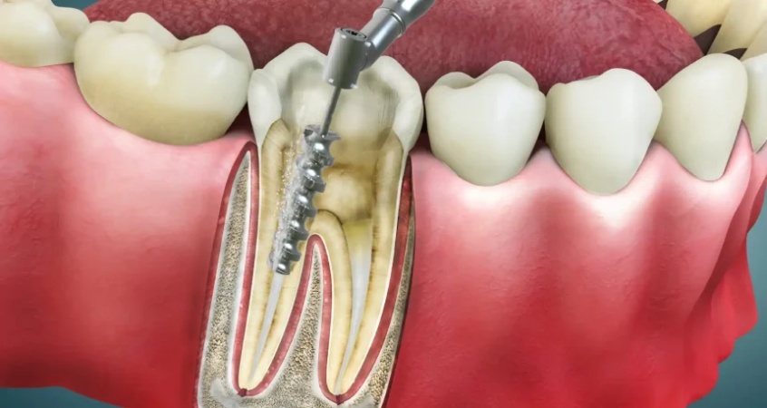 Root canal treatment may cut heart disease risk — Study