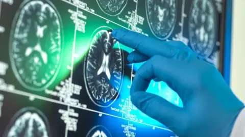 Breakthrough £90,000 Alzheimer's drugs unlikely to benefit patients, report suggests