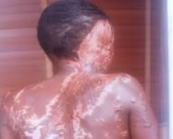 Lover’s rage: Lagos spa worker bathed in acid