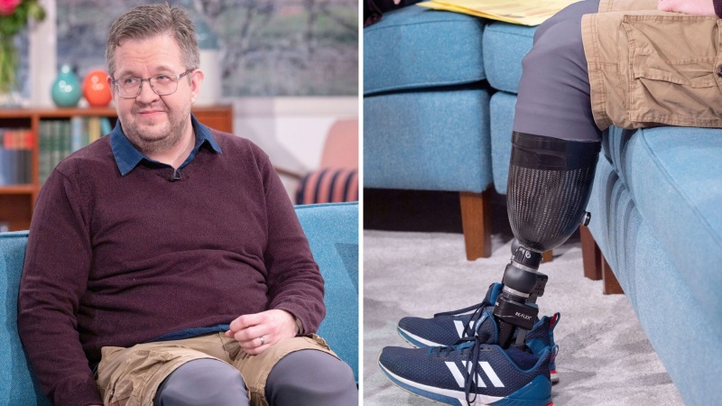 Surgeon amputates own legs to fulfill sexual fantasy
