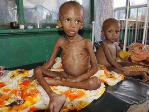 Surge in child malnutrition in Northern Nigerian worrisome ? Nwabueze