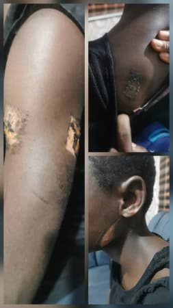 Police rescue teenage girl subjected to severe physical abuse, burnt with hot kitchen knife by guardian